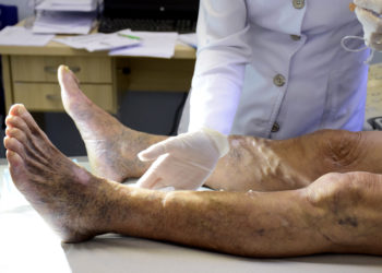 Tratamento de varizes por espuma é oferecido pelo SUS em Resende