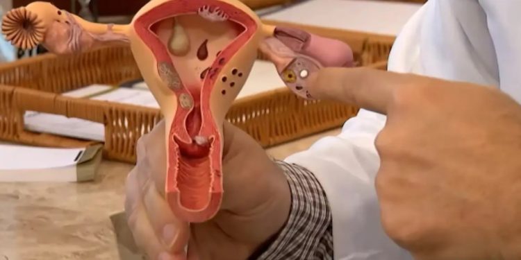 Conheça os sintomas da Endometriose e saiba como tratar a doença