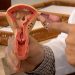 Conheça os sintomas da Endometriose e saiba como tratar a doença