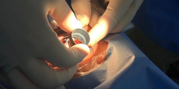 Volta Redonda: Hospital São João Batista realiza cirurgia oftalmológica de alta tecnologia